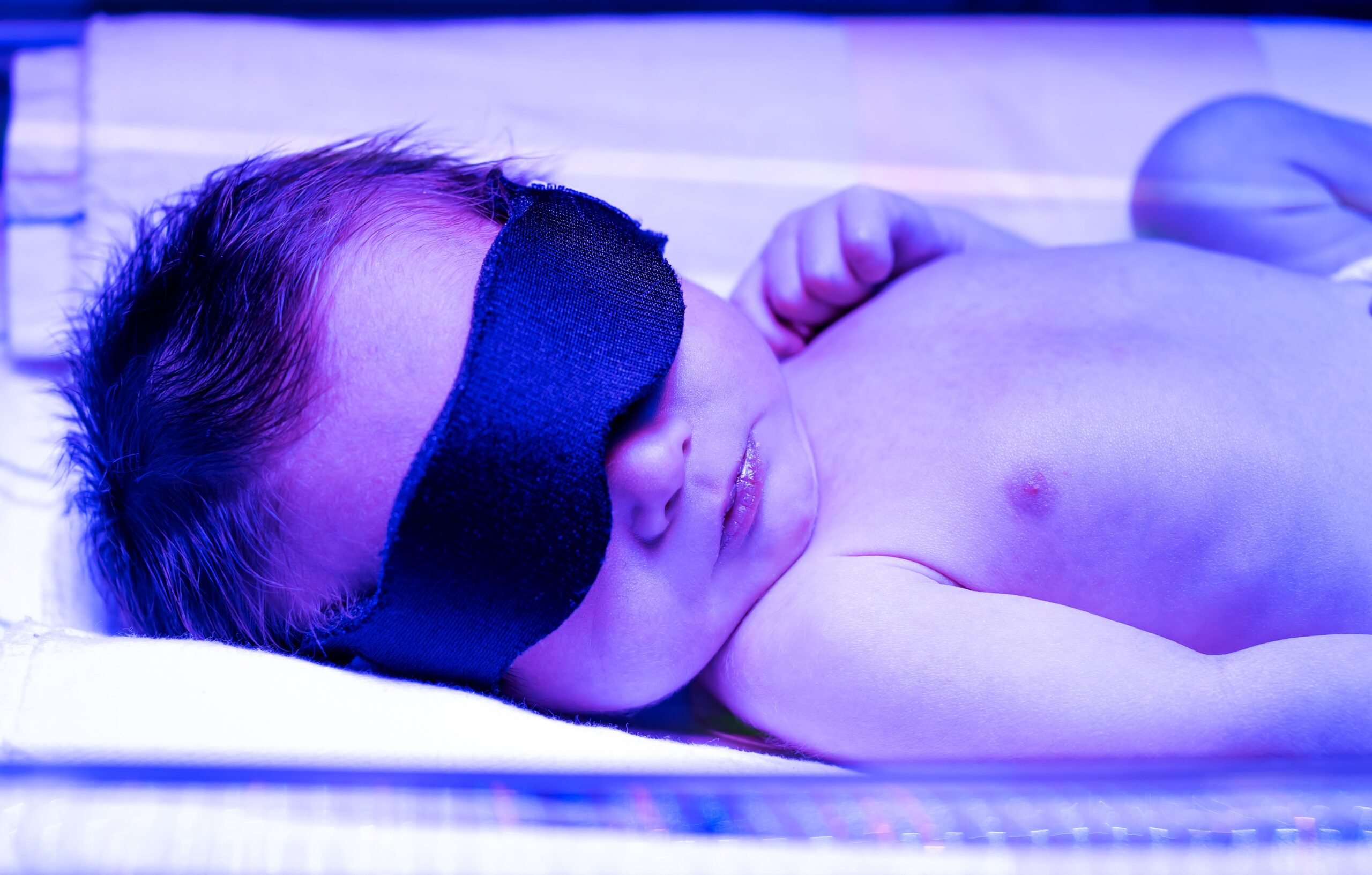 צהבת יילודים